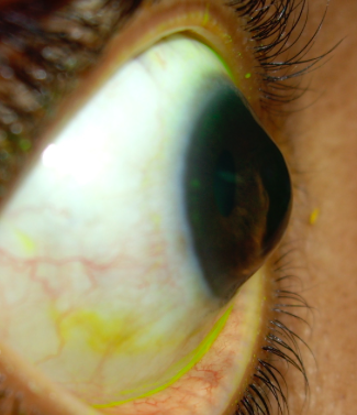 Keratoconus Eye
